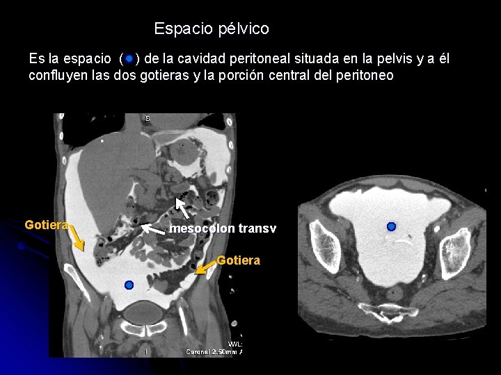 Espacio pélvico Es la espacio ( ) de la cavidad peritoneal situada en la