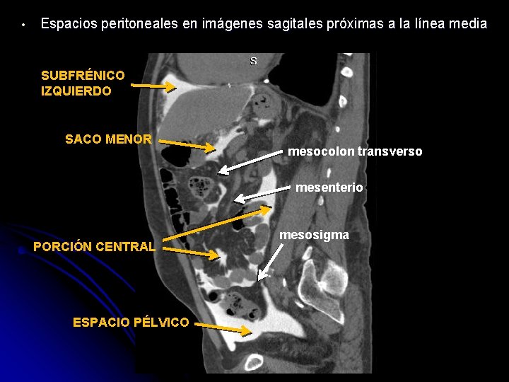  • Espacios peritoneales en imágenes sagitales próximas a la línea media SUBFRÉNICO IZQUIERDO