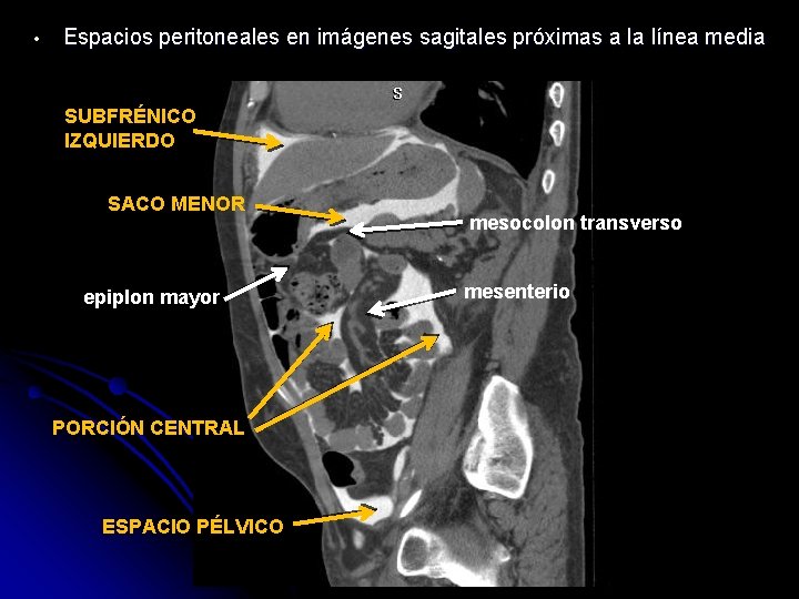  • Espacios peritoneales en imágenes sagitales próximas a la línea media SUBFRÉNICO IZQUIERDO