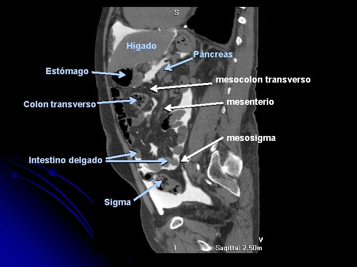 Hígado Estómago Páncreas mesocolon transverso mesenterio Colon transverso mesosigma Intestino delgado Sigma 