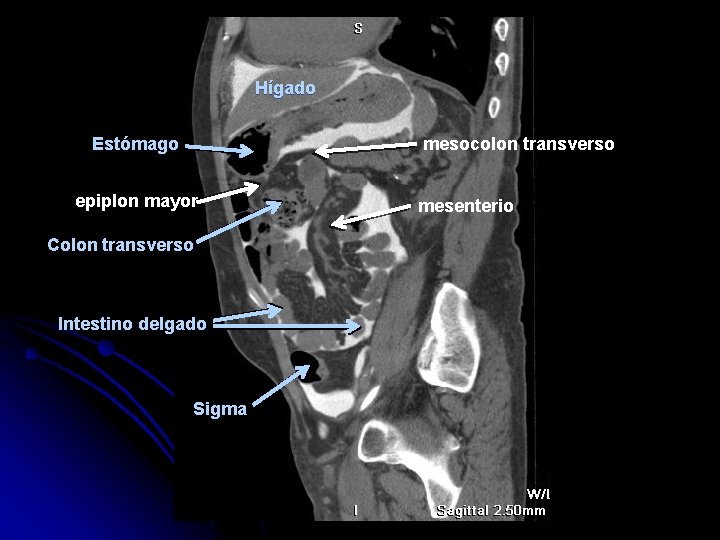 Hígado mesocolon transverso Estómago epiplon mayor Colon transverso Intestino delgado Sigma mesenterio 