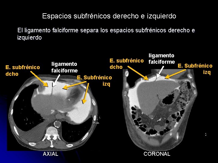 Espacios subfrénicos derecho e izquierdo El ligamento falciforme separa los espacios subfrénicos derecho e