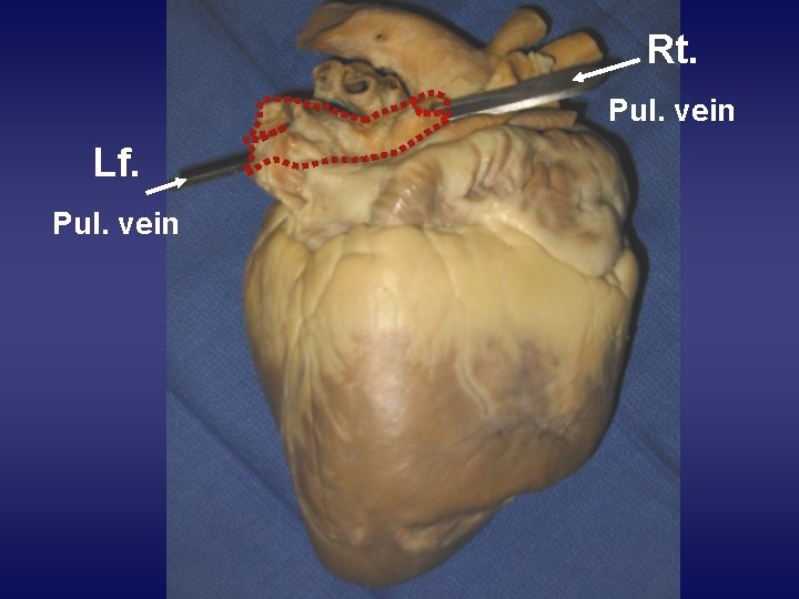 Rt. Pul. vein Lf. Pul. vein 