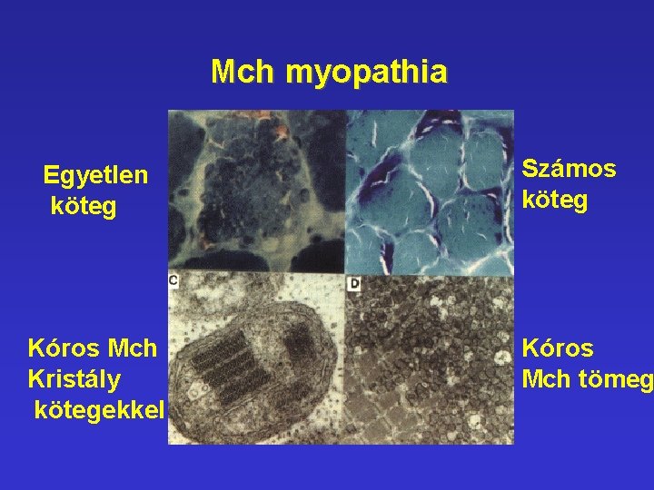 Mch myopathia Egyetlen köteg Kóros Mch Kristály kötegekkel Számos köteg Kóros Mch tömeg Mch myopathia Egyetlen köteg Kóros Mch Kristály kötegekkel Számos köteg Kóros Mch tömeg