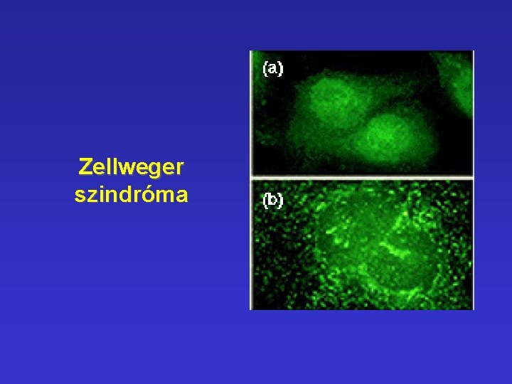 Zellweger szindróma Zellweger szindróma