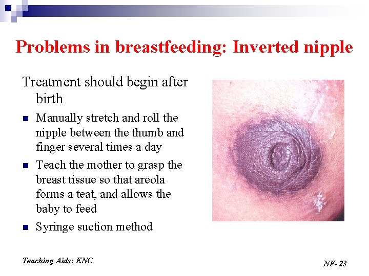 Problems in breastfeeding: Inverted nipple Treatment should begin after birth n n n Manually
