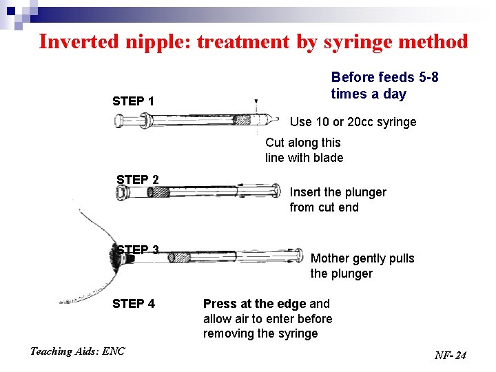 Inverted nipple: treatment by syringe method STEP 1 Before feeds 5 -8 times a