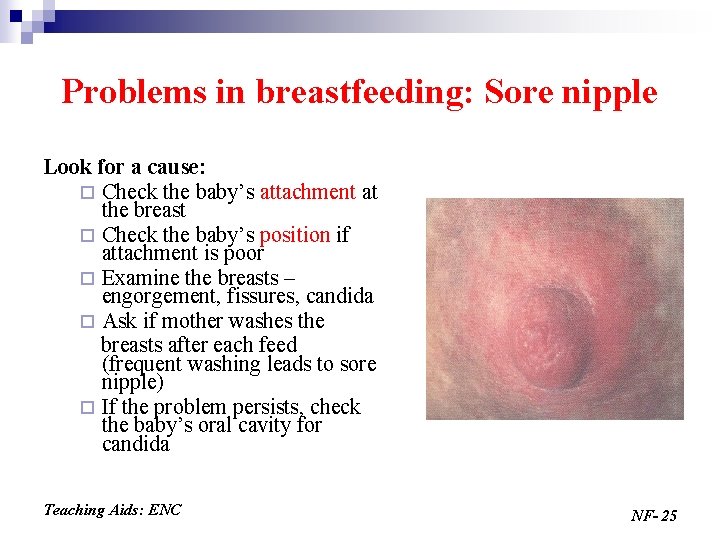 Problems in breastfeeding: Sore nipple Look for a cause: ¨ Check the baby’s attachment