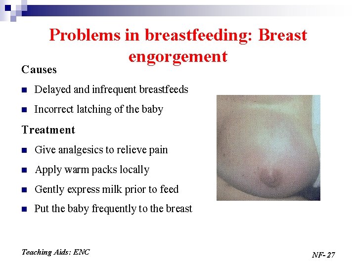 Problems in breastfeeding: Breast engorgement Causes n Delayed and infrequent breastfeeds n Incorrect latching