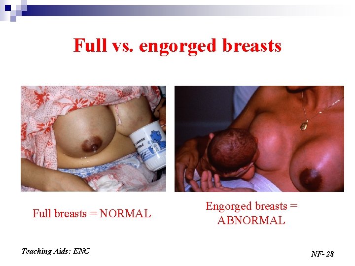 Full vs. engorged breasts Full breasts = NORMAL Teaching Aids: ENC Engorged breasts =
