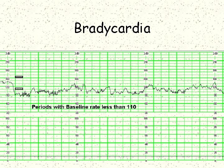 Bradycardia 
