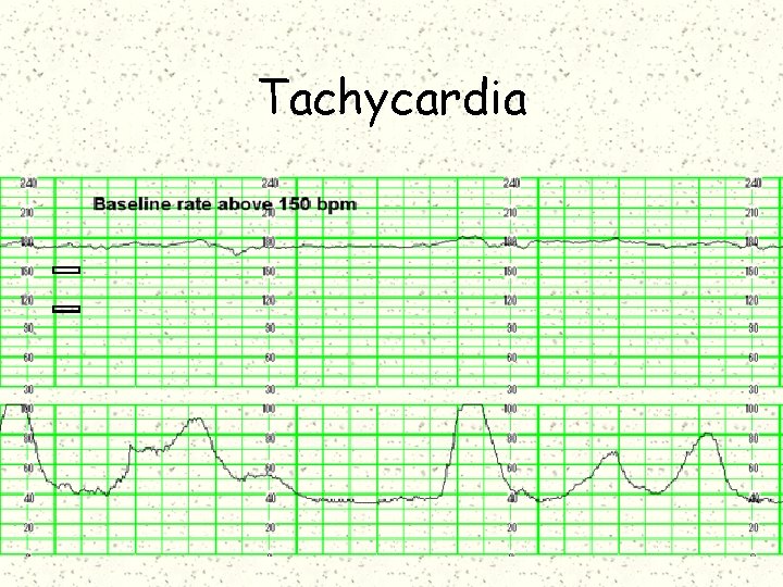 Tachycardia 