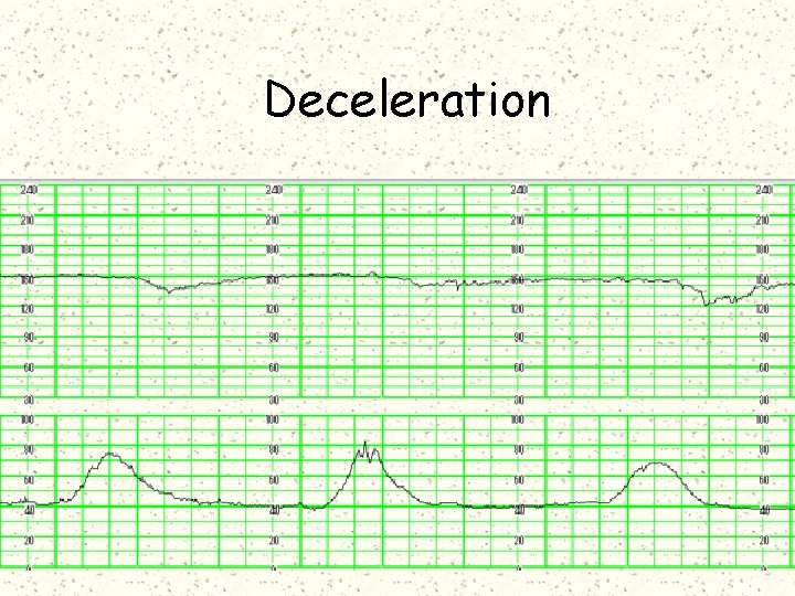Deceleration 