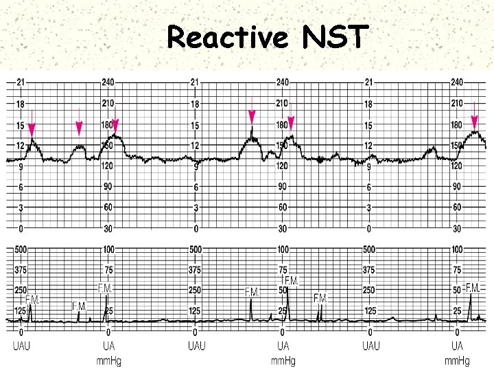 Reactive NST 