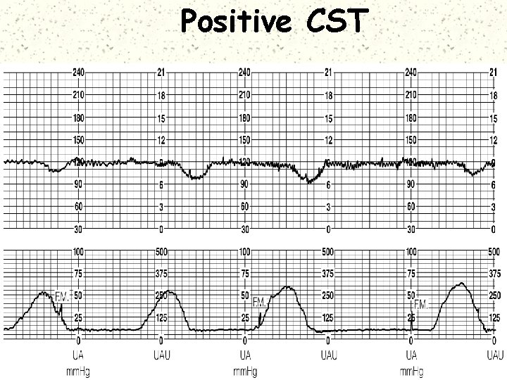 Positive CST 