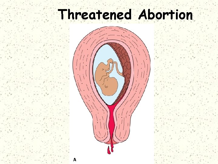 Threatened Abortion 