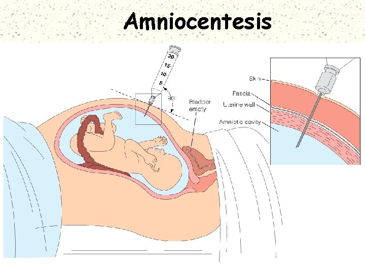 Amniocentesis 