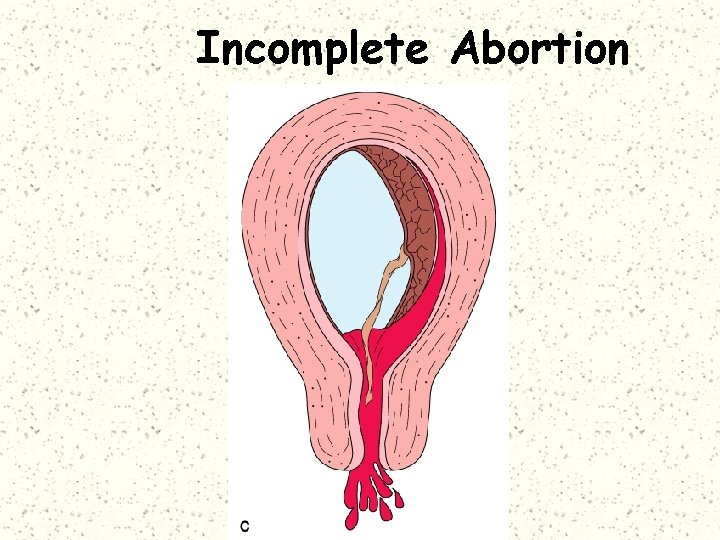Incomplete Abortion 