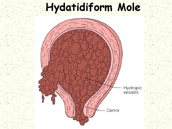 Hydatidiform Mole 