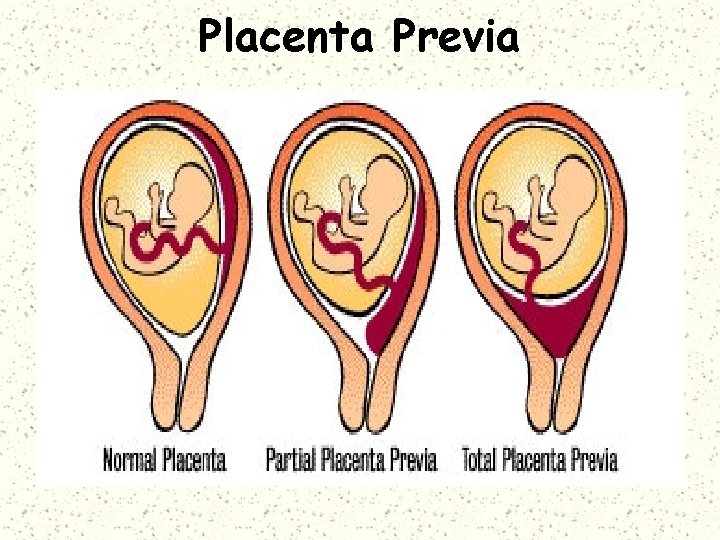 Placenta Previa 