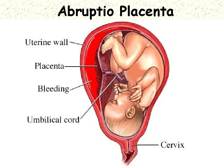 Abruptio Placenta 