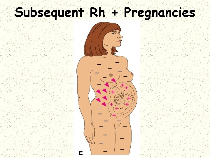 Subsequent Rh + Pregnancies 