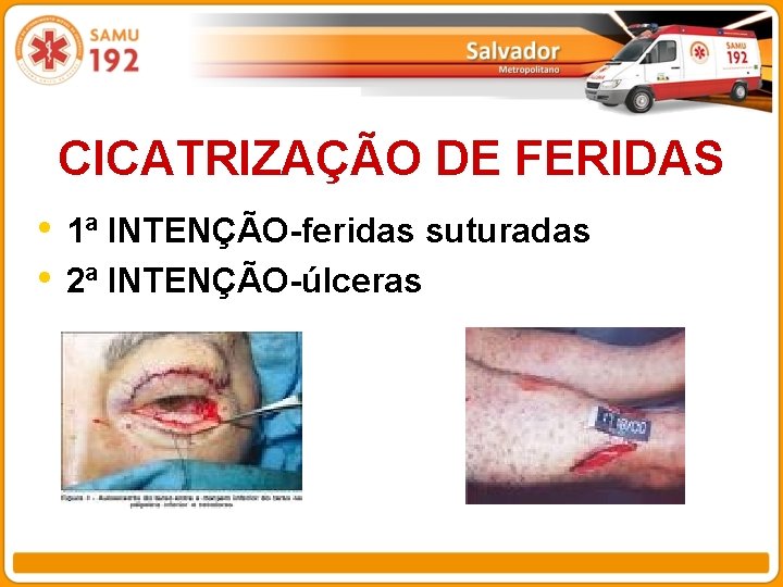 CICATRIZAÇÃO DE FERIDAS • 1ª INTENÇÃO-feridas suturadas • 2ª INTENÇÃO-úlceras 