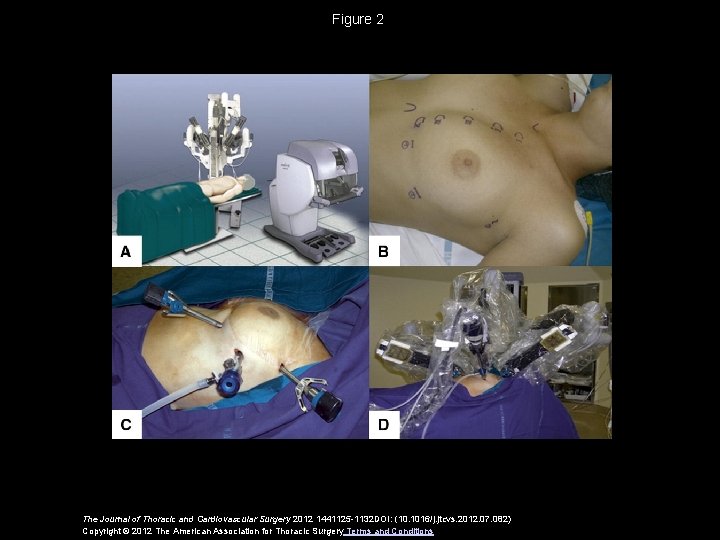 Figure 2 The Journal of Thoracic and Cardiovascular Surgery 2012 1441125 -1132 DOI: (10.
