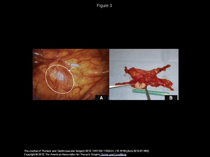Figure 3 The Journal of Thoracic and Cardiovascular Surgery 2012 1441125 -1132 DOI: (10.