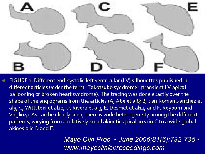  FIGURE 1. Different end-systolic left ventricular (LV) silhouettes published in different articles under
