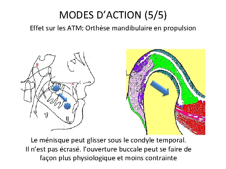 MODES D’ACTION (5/5) Effet sur les ATM: Orthèse mandibulaire en propulsion Le ménisque peut