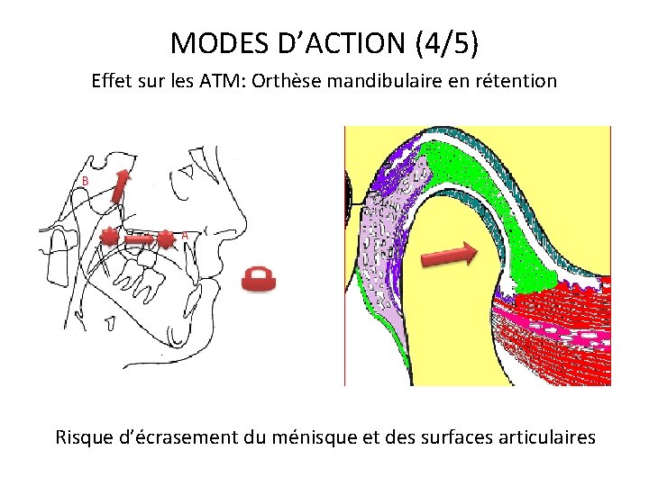 MODES D’ACTION (4/5) Effet sur les ATM: Orthèse mandibulaire en rétention Risque d’écrasement du