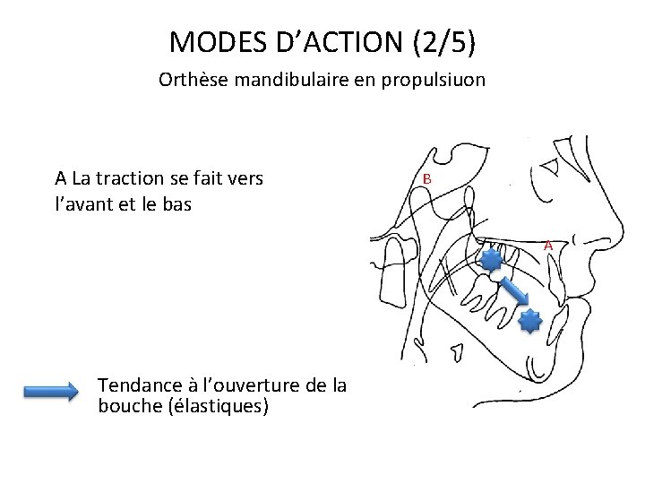 MODES D’ACTION (2/5) Orthèse mandibulaire en propulsiuon A La traction se fait vers l’avant
