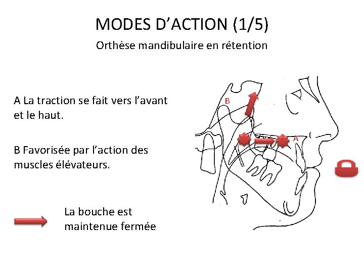 MODES D’ACTION (1/5) Orthèse mandibulaire en rétention A La traction se fait vers l’avant