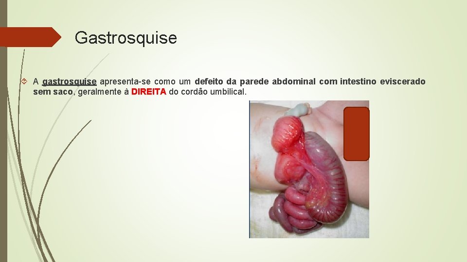 Gastrosquise A gastrosquise apresenta-se como um defeito da parede abdominal com intestino eviscerado sem