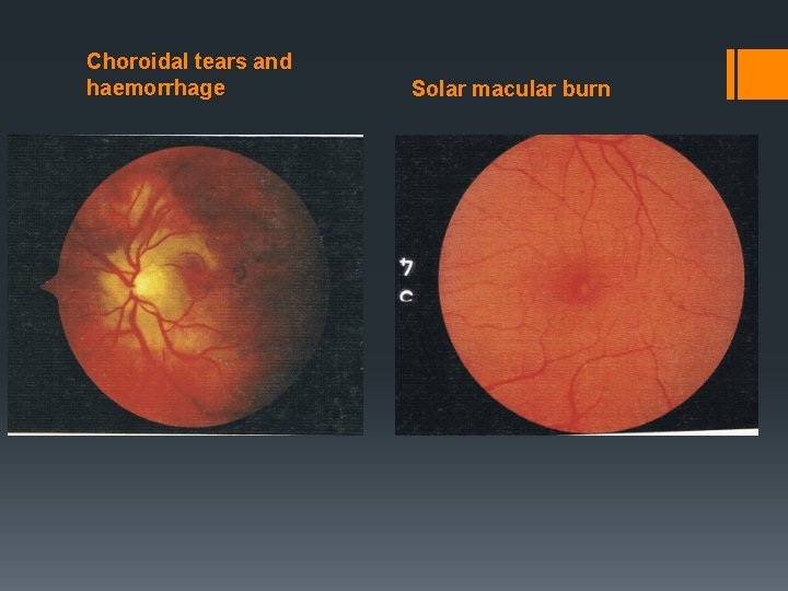 Choroidal tears and haemorrhage Solar macular burn 