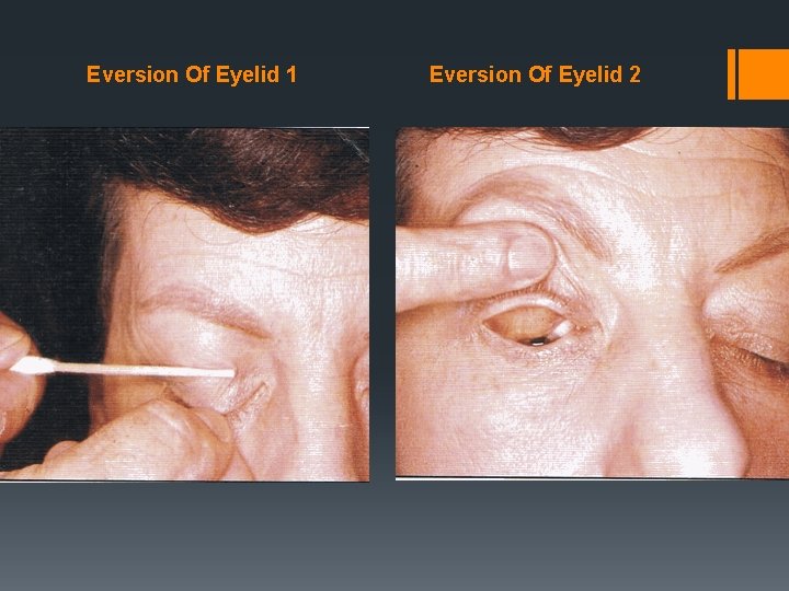 Eversion Of Eyelid 1 Eversion Of Eyelid 2 