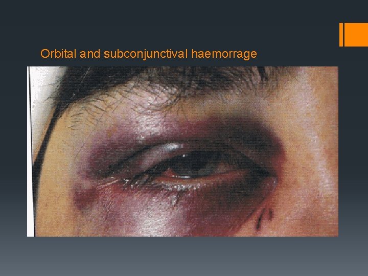 Orbital and subconjunctival haemorrage 