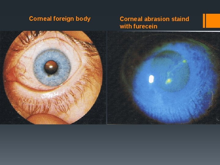 Corneal foreign body Corneal abrasion staind with furecein 