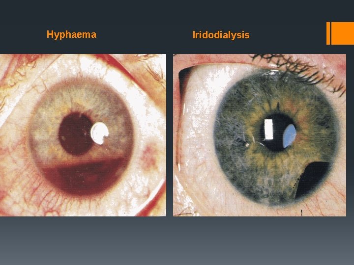 Hyphaema Iridodialysis 