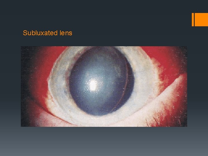 Subluxated lens 