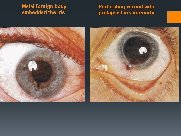 Metal foreign body embedded the iris Perforating wound with prolapsed iris inferiorly 