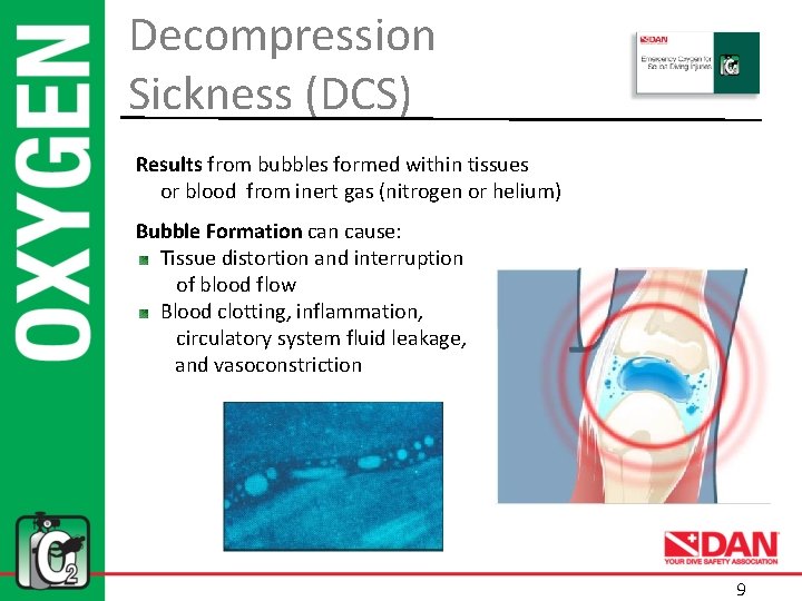 Decompression Sickness (DCS) Results from bubbles formed within tissues or blood from inert gas