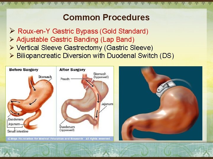 Common Procedures Ø Roux-en-Y Gastric Bypass (Gold Standard) Ø Adjustable Gastric Banding (Lap Band)