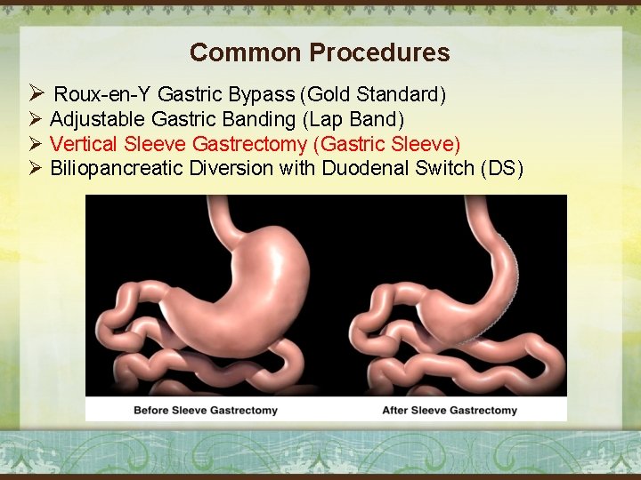 Common Procedures Ø Roux-en-Y Gastric Bypass (Gold Standard) Ø Adjustable Gastric Banding (Lap Band)