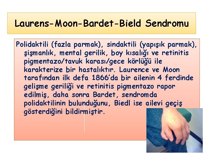 Laurens-Moon-Bardet-Bield Sendromu Polidaktili (fazla parmak), sindaktili (yapışık parmak), şişmanlık, mental gerilik, boy kısalığı ve