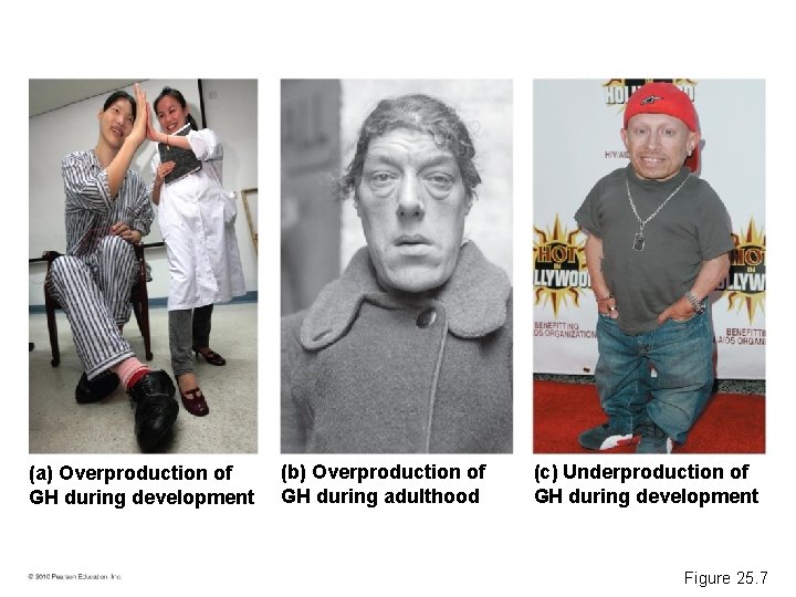 (a) Overproduction of GH during development (b) Overproduction of GH during adulthood (c) Underproduction