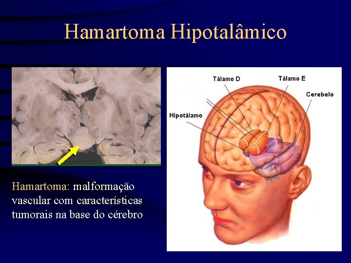 Hamartoma Hipotalâmico Hamartoma: malformação vascular com características tumorais na base do cérebro 7 