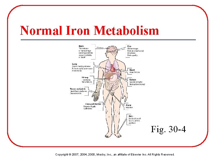 Normal Iron Metabolism Fig. 30 -4 Copyright © 2007, 2004, 2000, Mosby, Inc. ,