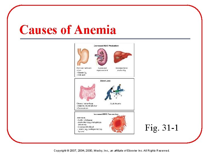 Causes of Anemia Fig. 31 -1 Copyright © 2007, 2004, 2000, Mosby, Inc. ,